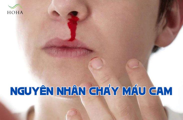 Nguyên nhân chảy máu cam thường gặp